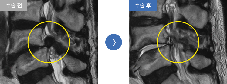 양방향 내시경술 수술 전후 case02